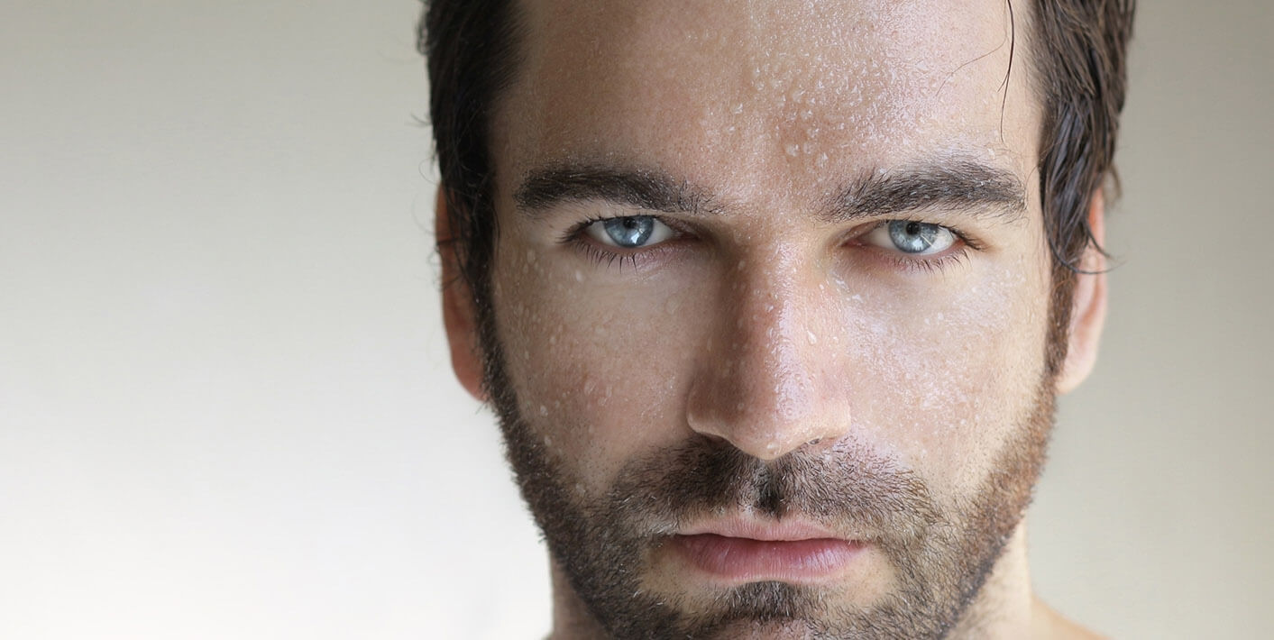 Hiperidrose Craniofacial